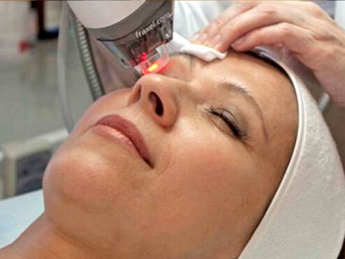peremajaan laser pada kulit di sekitar mata